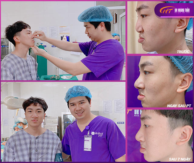 kết quả chỉnh hình mũi dị tật Thẩm Mỹ Hoàng Tuấn